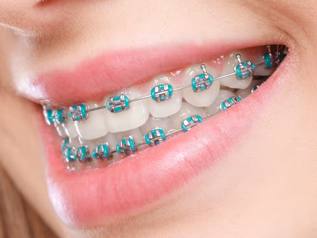Dental Braces