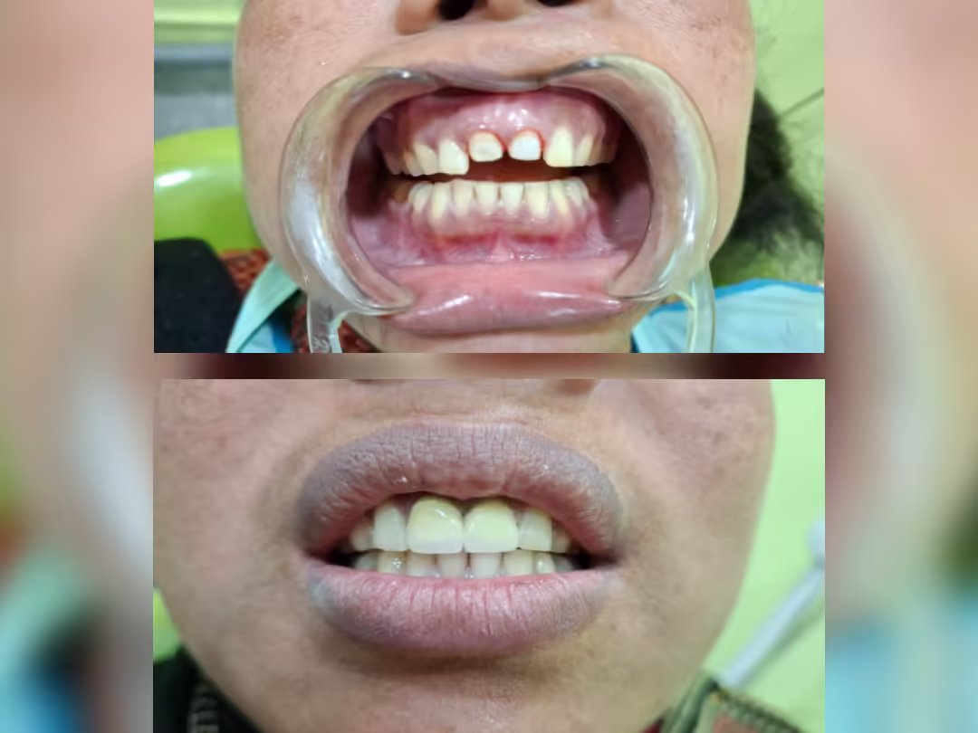 Dental Crowns