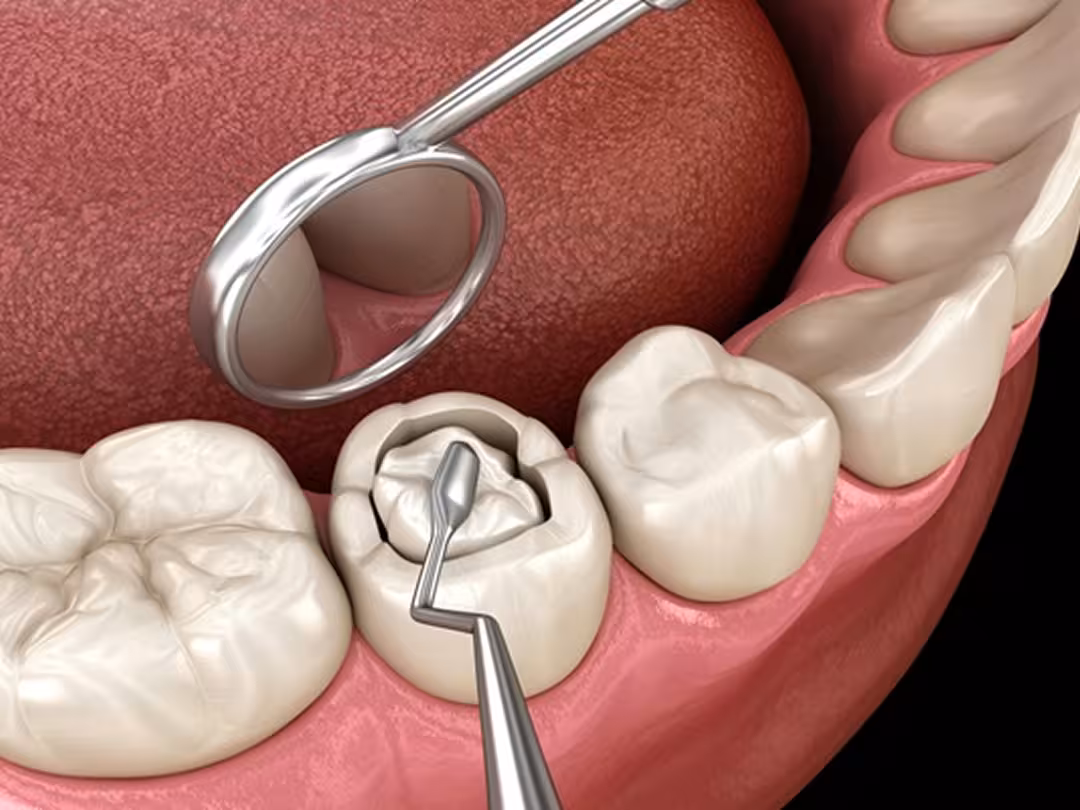 Dental Filling