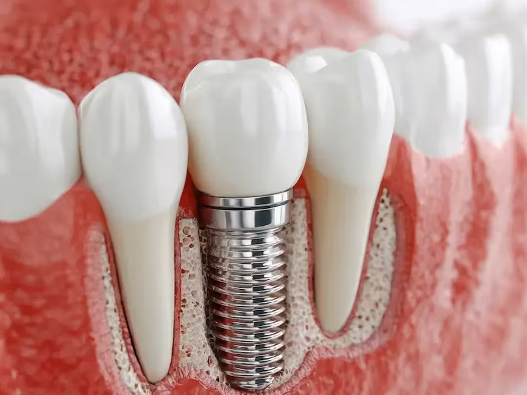 Dental Implants