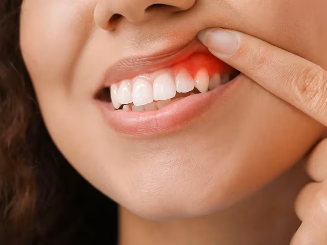 Gum Treatment