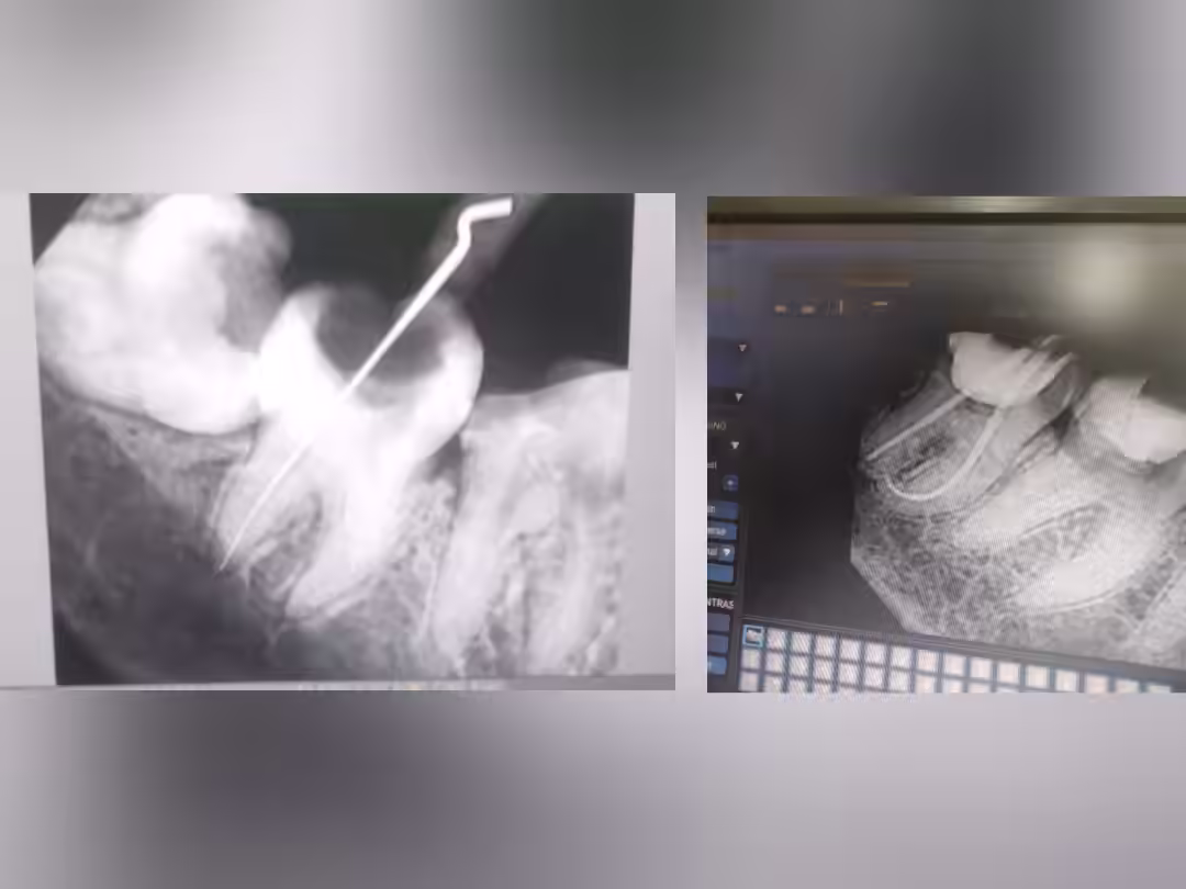 Root Canal